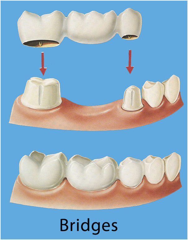 Close-up of dental bridges and implants in Indore, showcasing dental crowns and bridges.